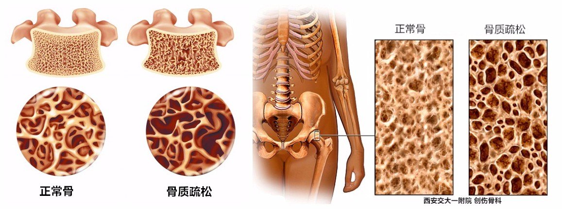 老年人骨质疏松性骨折手术后还需要怎么治疗?_骨质疏松_手术_治疗方法