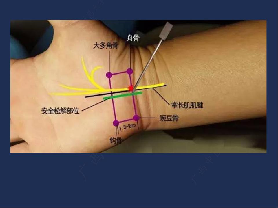 针刀治疗腕管综合征王明杰广西中医药大学专家楼