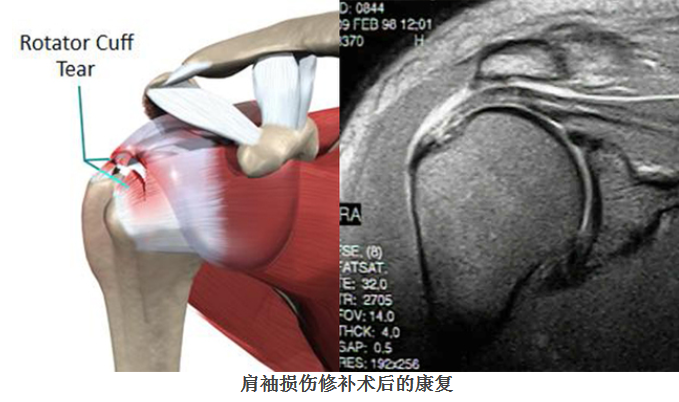 肩袖損傷修補術後的康復