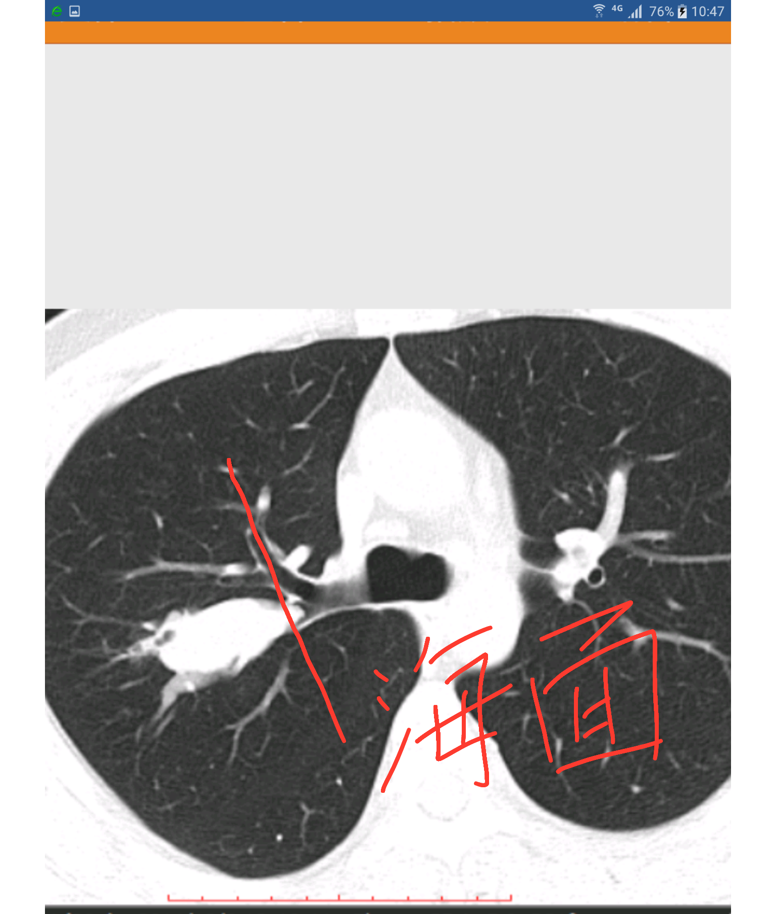 六、肺类癌-呼吸系统-医学