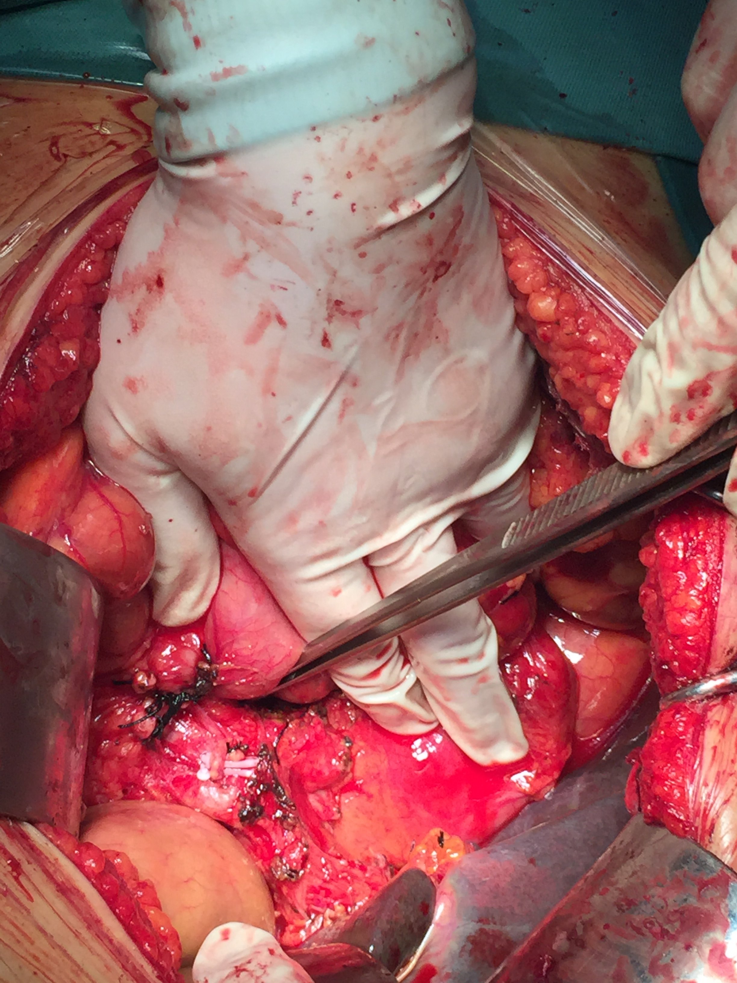 一见此图立刻就做超级大手术即胰十二指肠切除术 - 好大夫在线