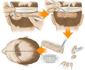 植发后,后枕部的头发会变秃吗?