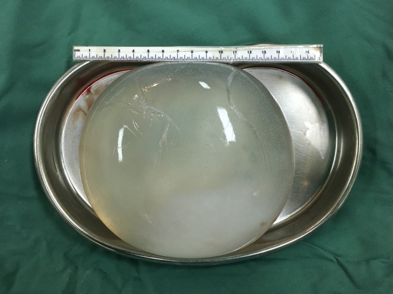 根据影像学特征,入院初步诊断:脑包虫病.