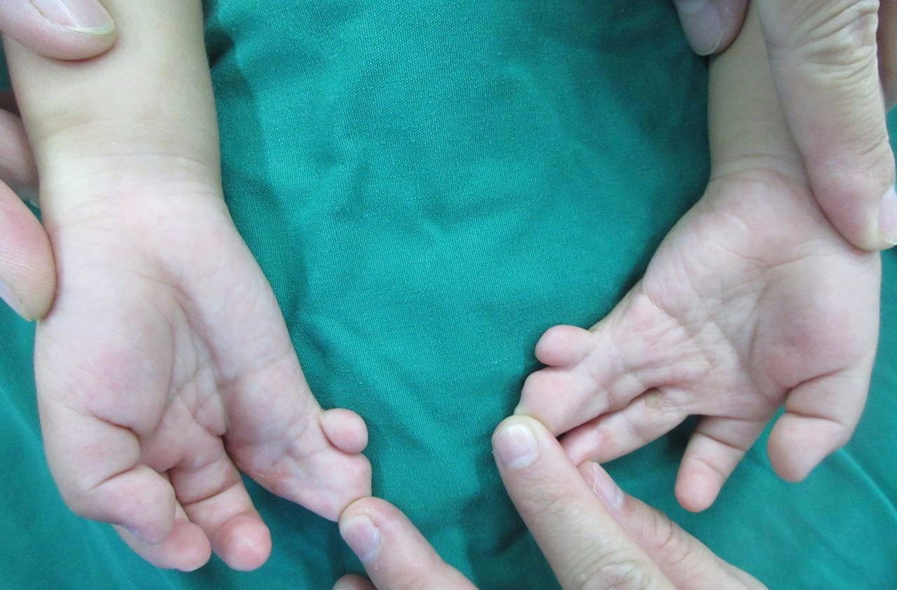 个月双手照片:先天性并指畸形如何治疗患儿术后一个月双手指体外形可