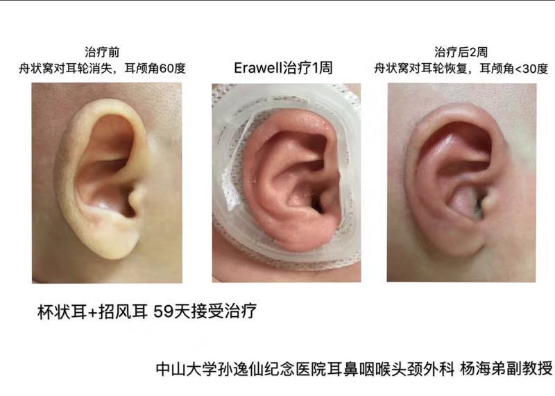 唐氏宝宝的特征耳朵图片