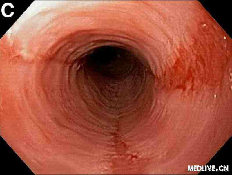 关于胃心综合征脚鸡皮疙瘩的信息 关于胃心综合征脚鸡皮疙瘩的信息