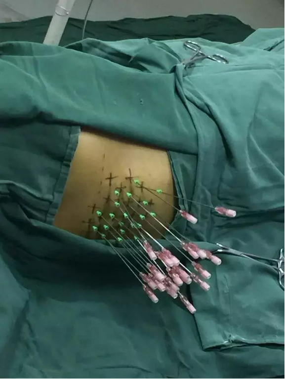 晚期肿瘤治疗又一利器--放射性粒子植入术 - 好大夫在线