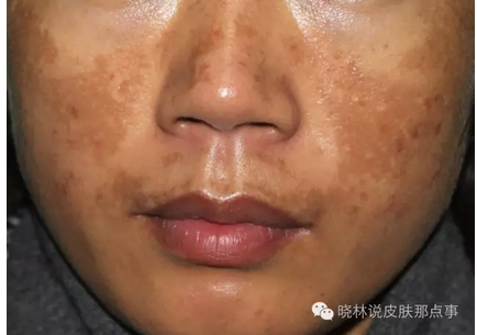 1黄褐斑:又称肝斑,蝴蝶斑.30岁之后的女性常见,但男性也有哦.