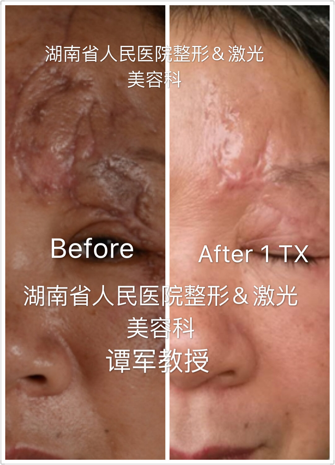 脚底黑痣癌变_黑痣癌变图片_黑痣会癌变吗