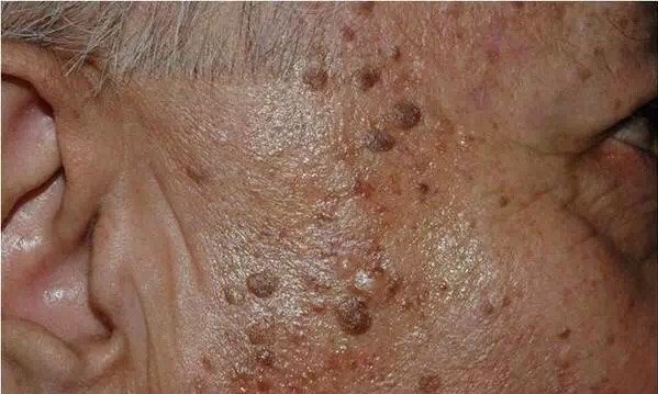 了解一下你属于哪种斑吧? - 好大夫在线