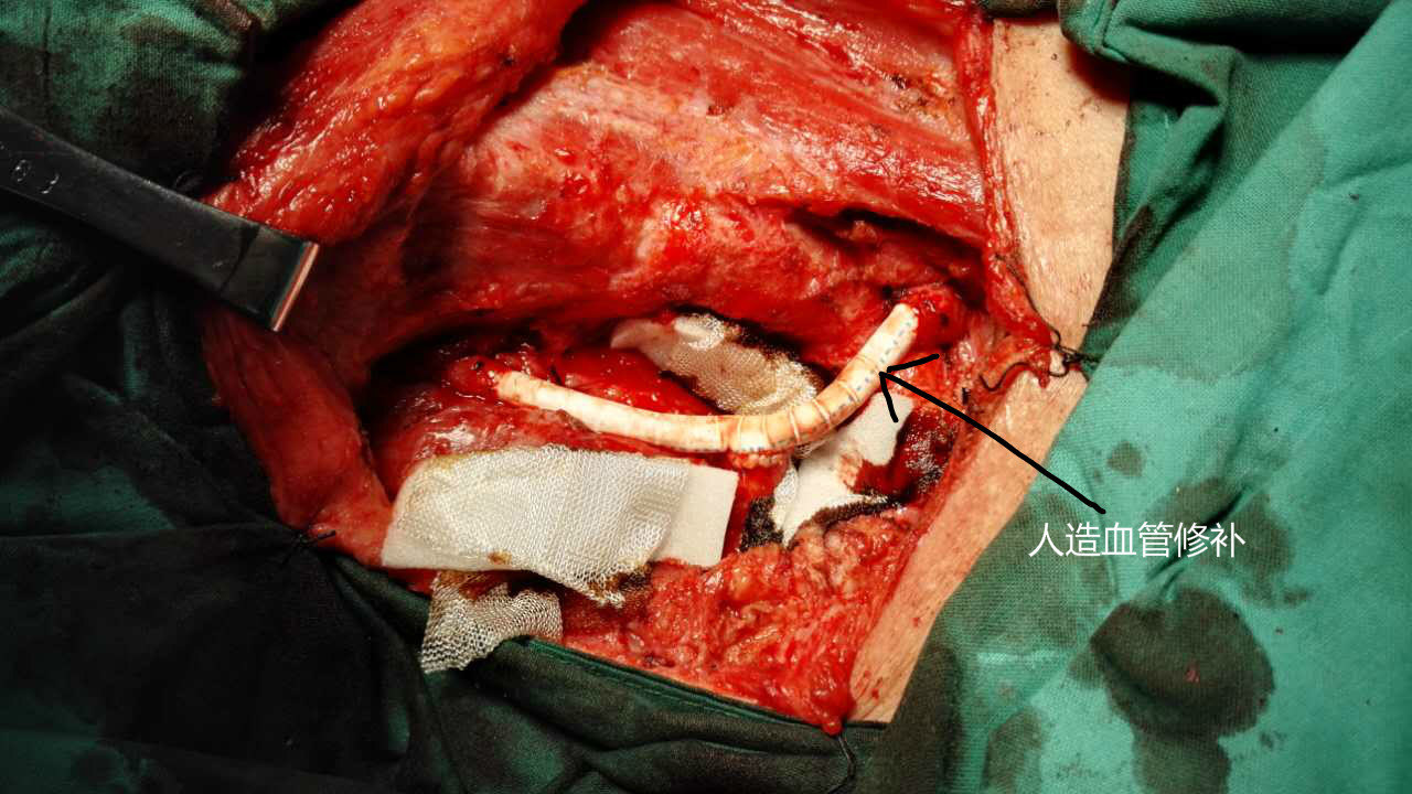 复发性甲状腺癌侵犯颈总动脉,锁骨下 动脉,无名动脉1例 - 好大夫在线