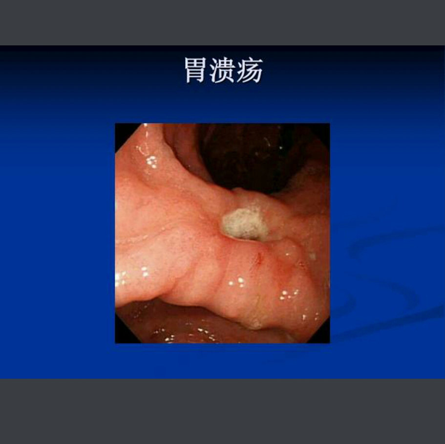 幽门螺杆菌和胃疾病_胃幽门螺杆菌感染_症状_检查_治疗方法_症状表现