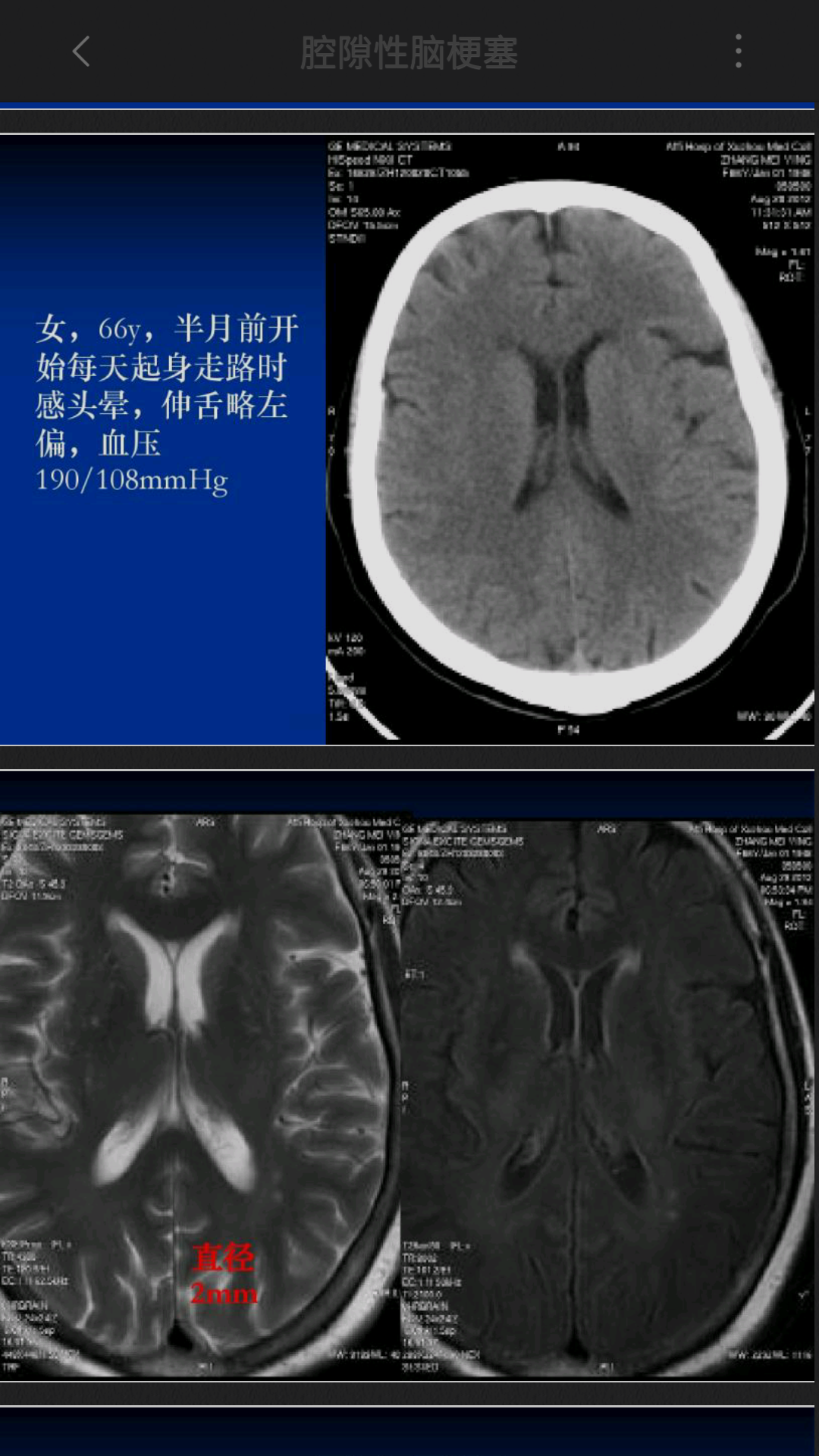 腔隙性脑梗死