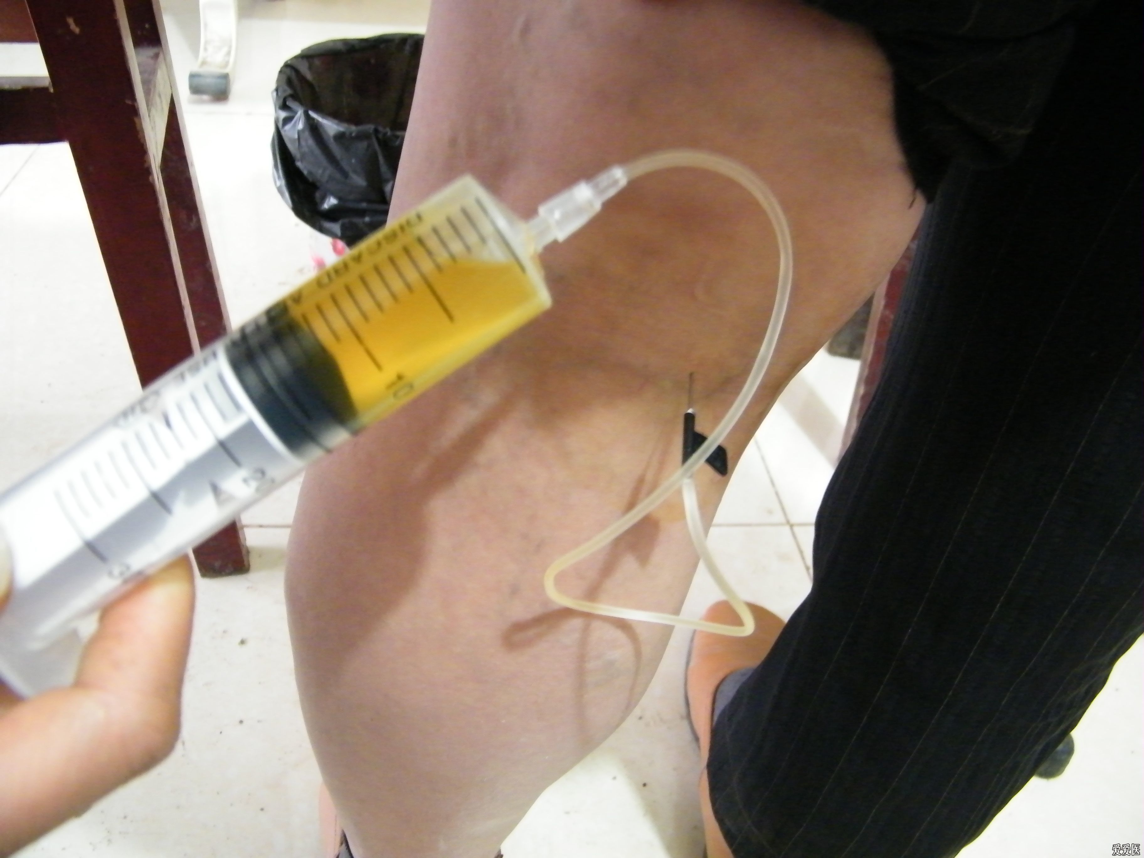 为什么会膝关节积液