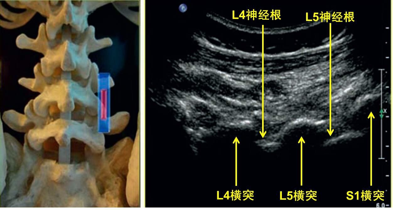 颈椎横突超声图像图片