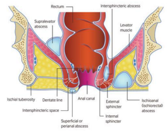 虽然不同的肛门直肠脓肿有严格的解剖学定义,在大多数病例中初期管理