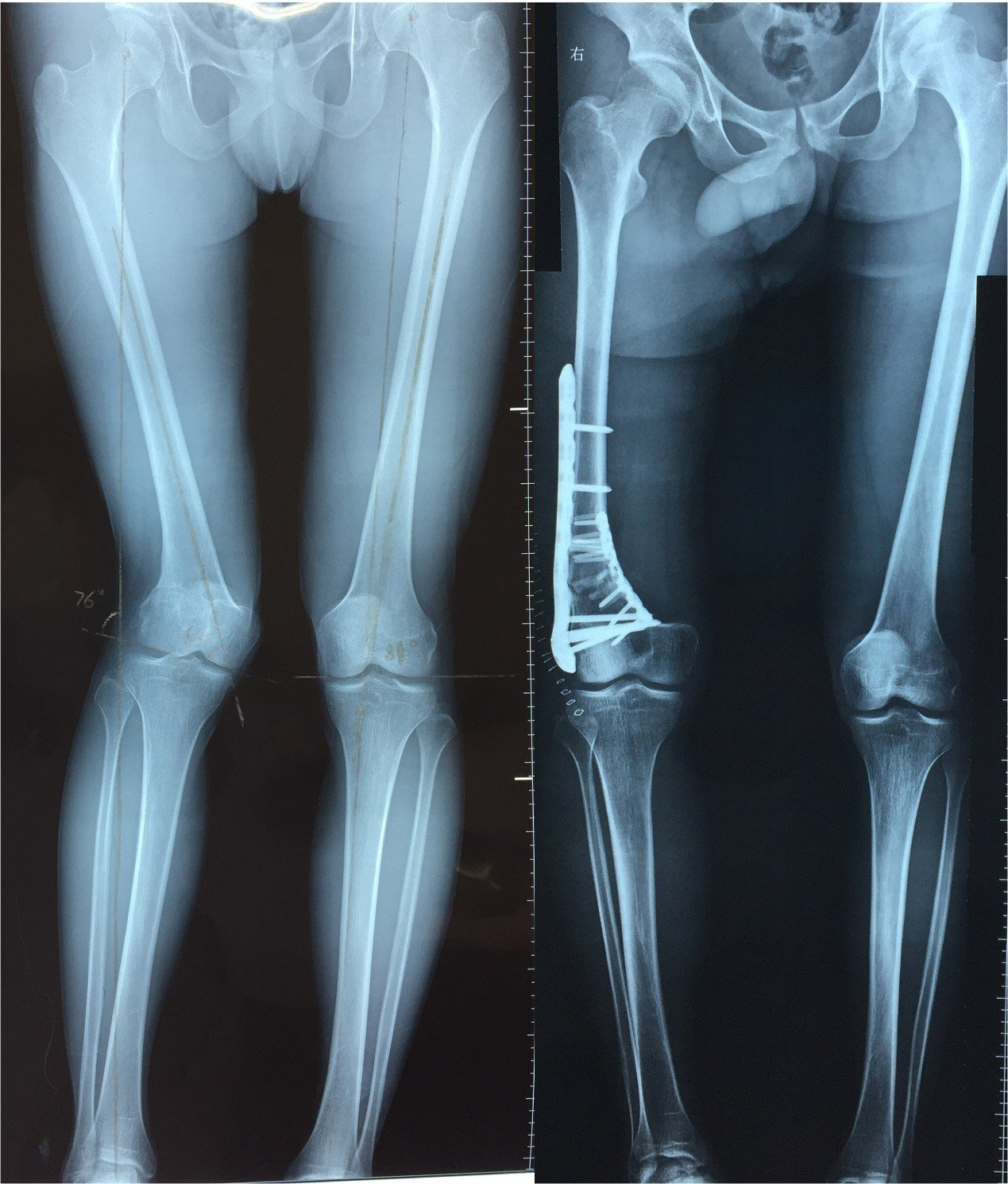 > 股骨发育严重畸形 3d打印技术让青年告别"鸭子