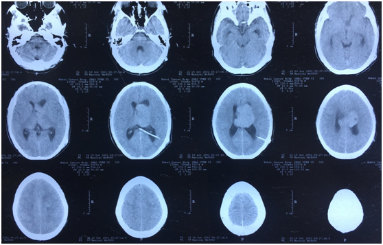 侧脑室巨大室管膜瘤15年诊治历程和心得 - 好大夫在线