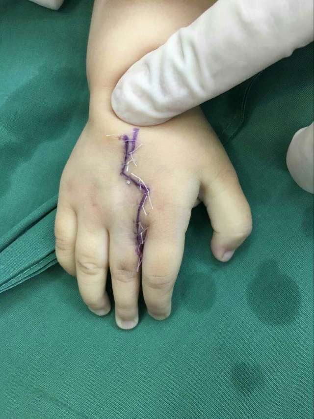 中央型多指一次手术后