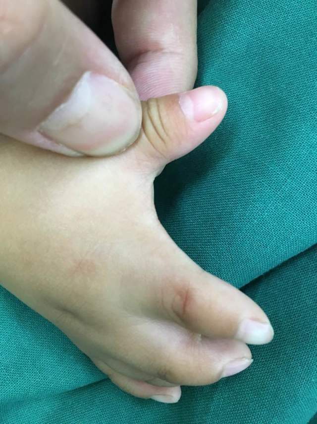 poland综合征四个指蹼一次手术全分开