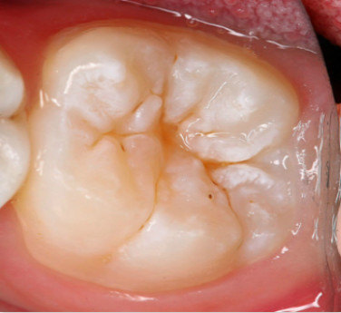 臼齿龋齿图片