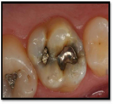下面三个牙齿均有点状的龋坏27岁,男性,数年年前补过的牙齿,继发龋坏