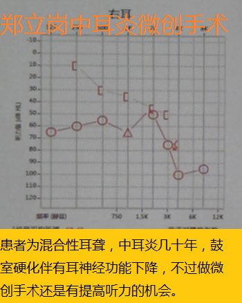 中耳乳突炎伴鼓室硬化耳内镜微创手术第428广