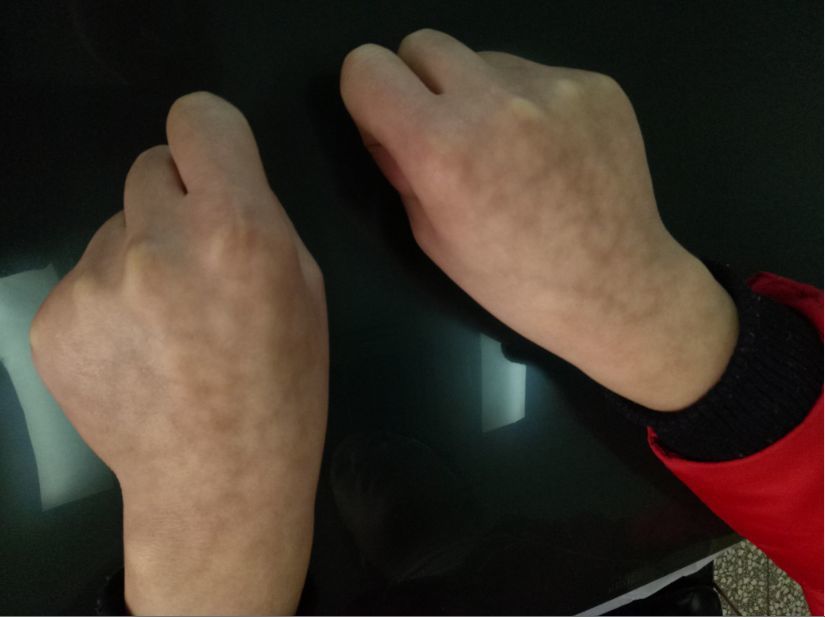 通过辨证论治,采用洛阳正骨传统方药三七接骨丸,顽痹康丸,结合国际