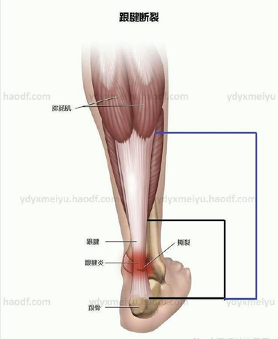 肌腱病 跟腱炎 运动时脚后跟痛该如何是好