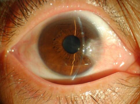 翼状胬肉_病因_症状_ - 好大夫在线