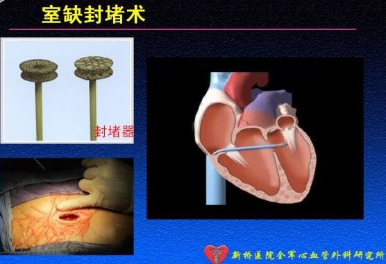 我们团队已成功施行房间隔缺损和室间隔缺损封堵术多例,积累了丰富的