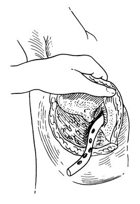 乳房脓肿切开引流术 - 好大夫在线