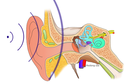 人工听骨形状图片