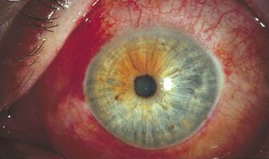 流行性角结膜炎 - 好大夫在线