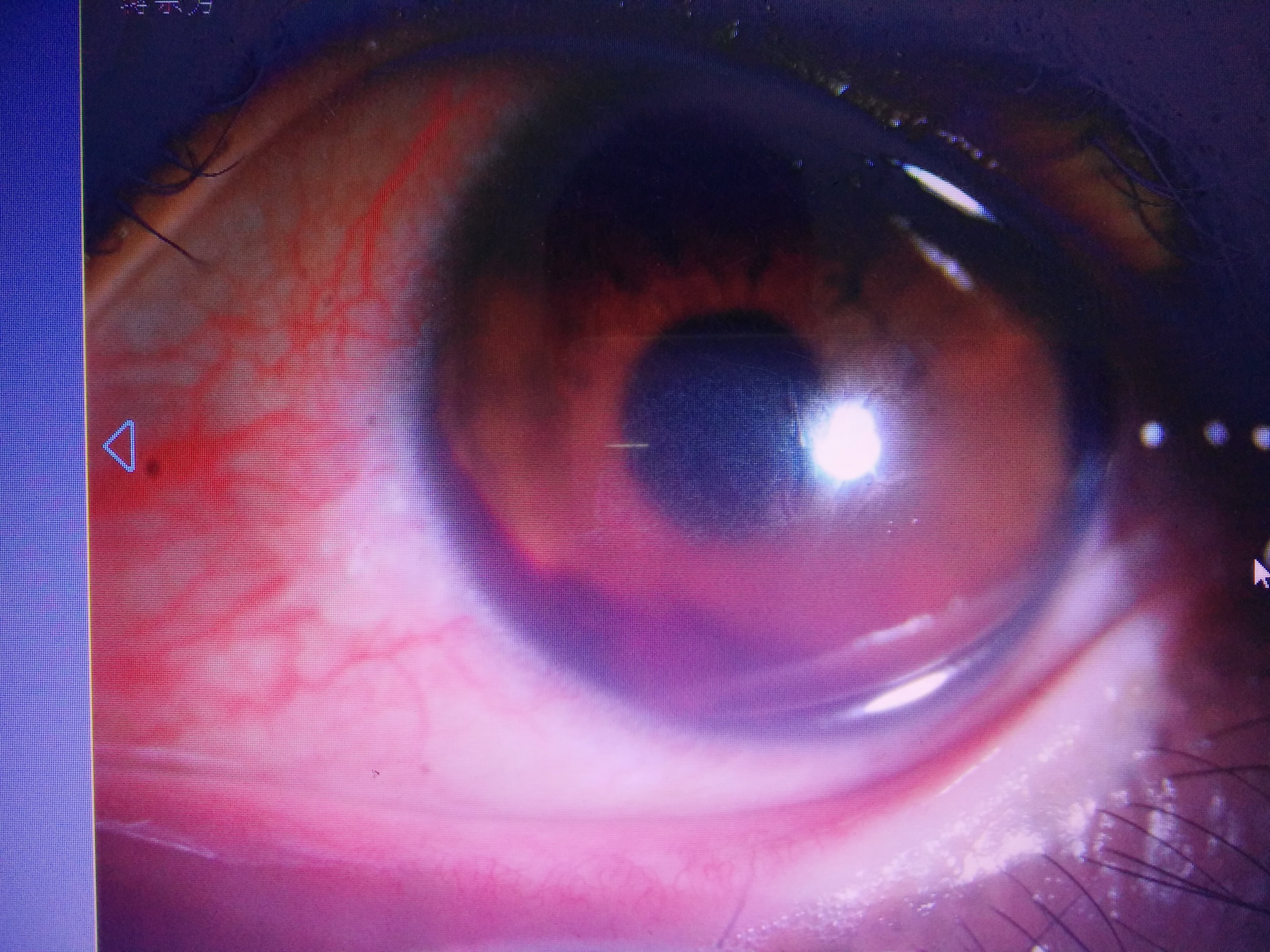 眼科医生教您实用性外伤性前房积血的治疗方法 眼外伤 眼外伤治疗方法