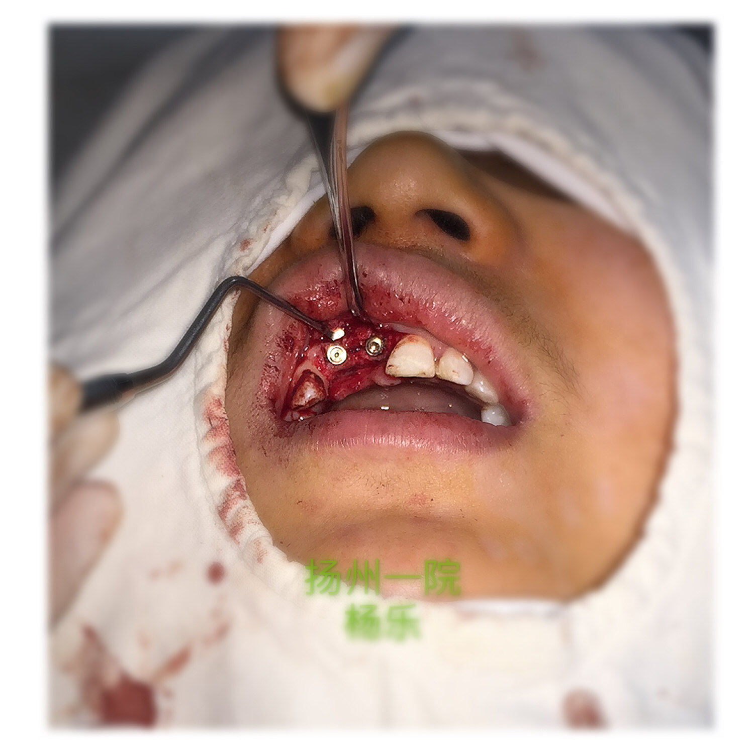 上前牙外伤缺失唇侧骨壁凹陷,种植术中行骨襞开增加丰满度.