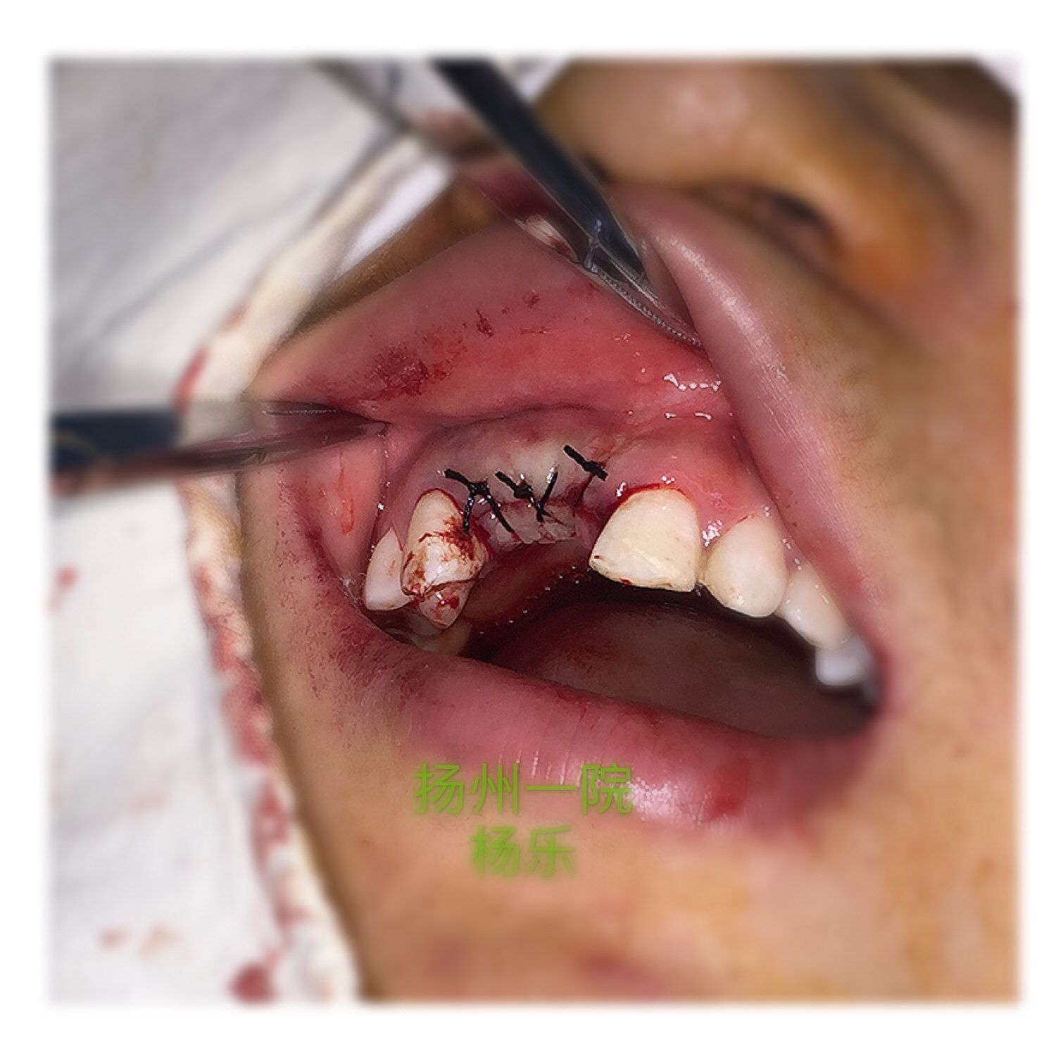 上前牙外伤缺失唇侧骨壁凹陷,种植术中行骨襞开增加丰满度.