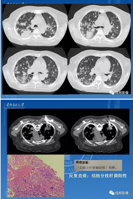 肺肉芽肿病变的影像表现和病理基础