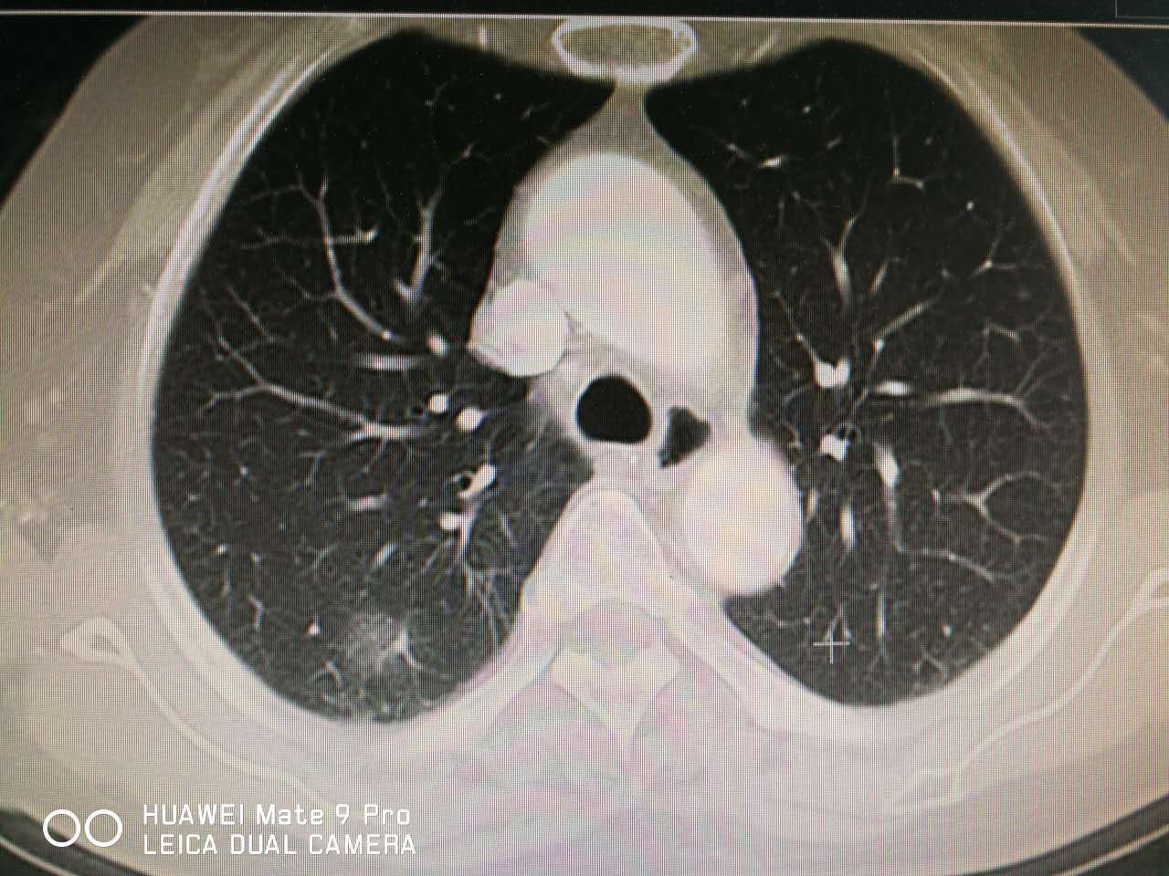 肺内斑片状影也有可能是肺癌