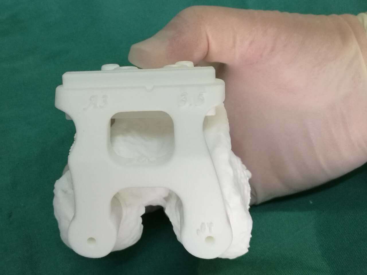 应用3d 打印导板截骨行膝关节置换治疗陈旧股骨骨折下肢畸 - 好大夫