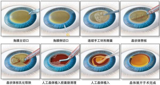 激光手术刀图解图片