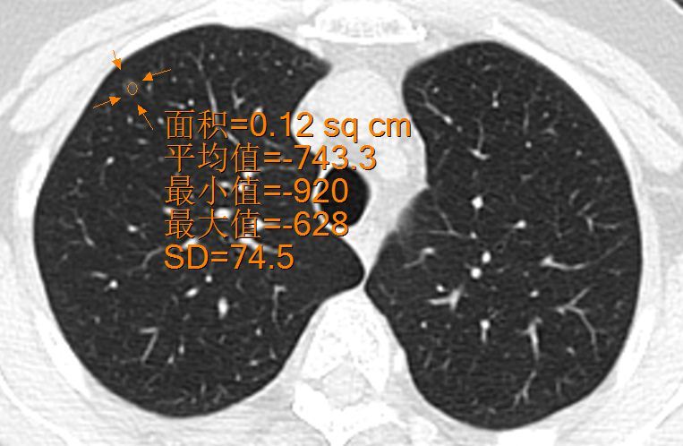 如何解讀磨玻璃結節的ct報告?
