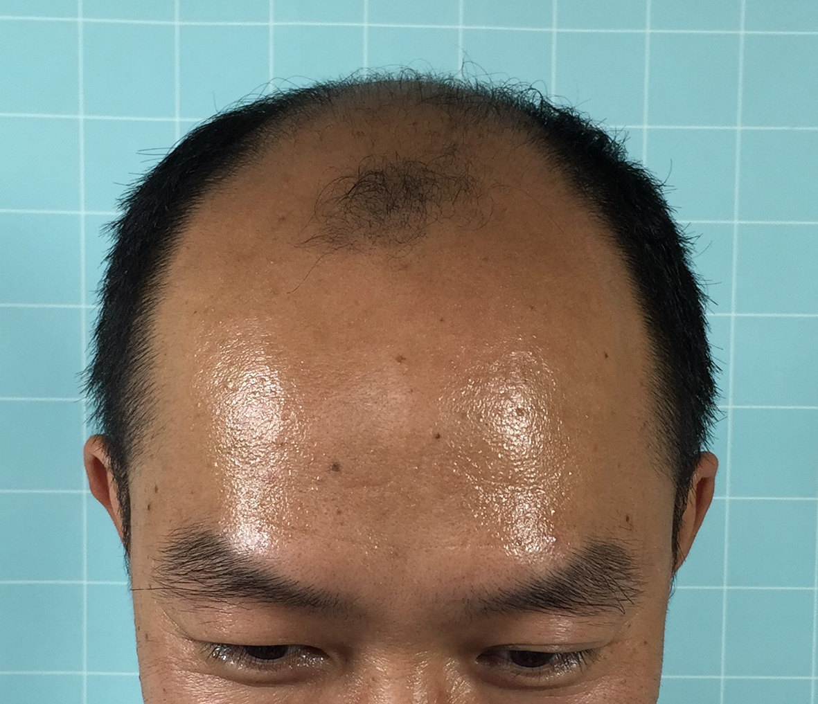 植发术后竟然是这样的.