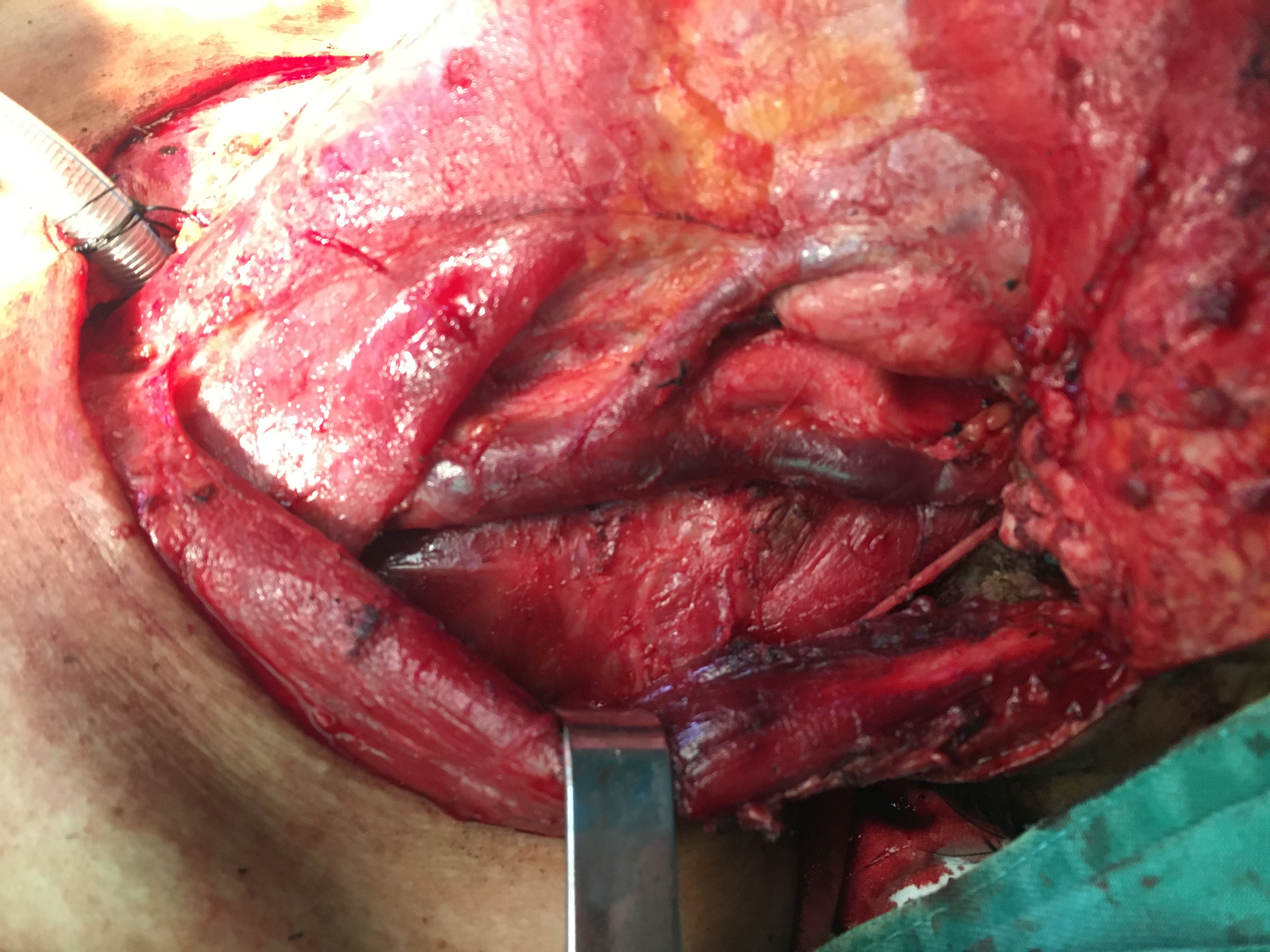 喉癌异物感一直在一个位置吗_喉癌异物感会时有时无码_喉咙异物感一个月喉癌