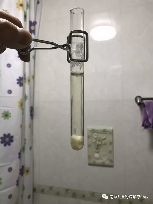 最快捷!观察尿中是否有蛋白的方法 - 好大夫在线