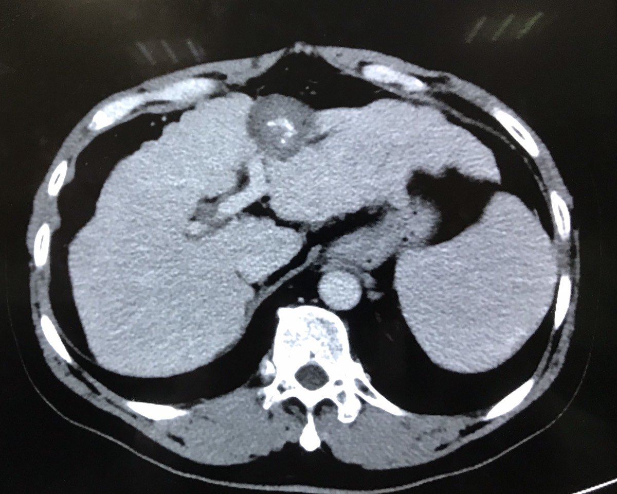 小肝癌该选择手术还是消融? - 好大夫在线