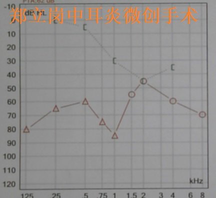 郑立岗中耳乳突炎耳内镜微创手术第584江西赣