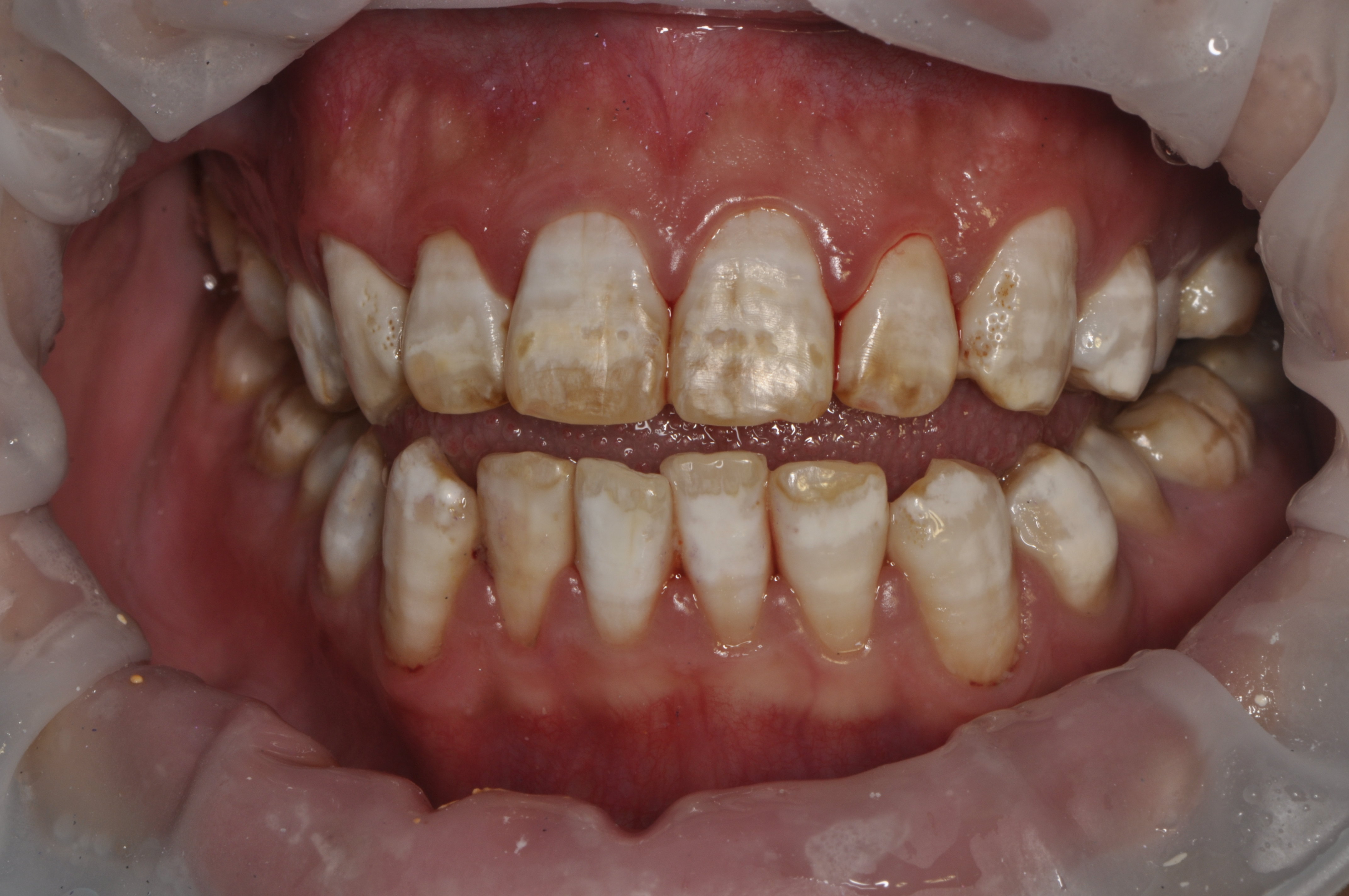 氟斑牙美白患者一例 