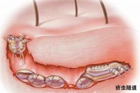 疥疮的预防与治疗