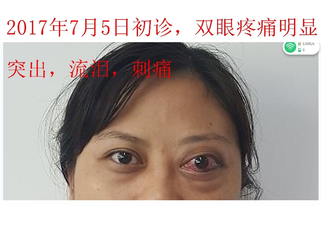 近期甲亢突眼患者治疗对照照片 